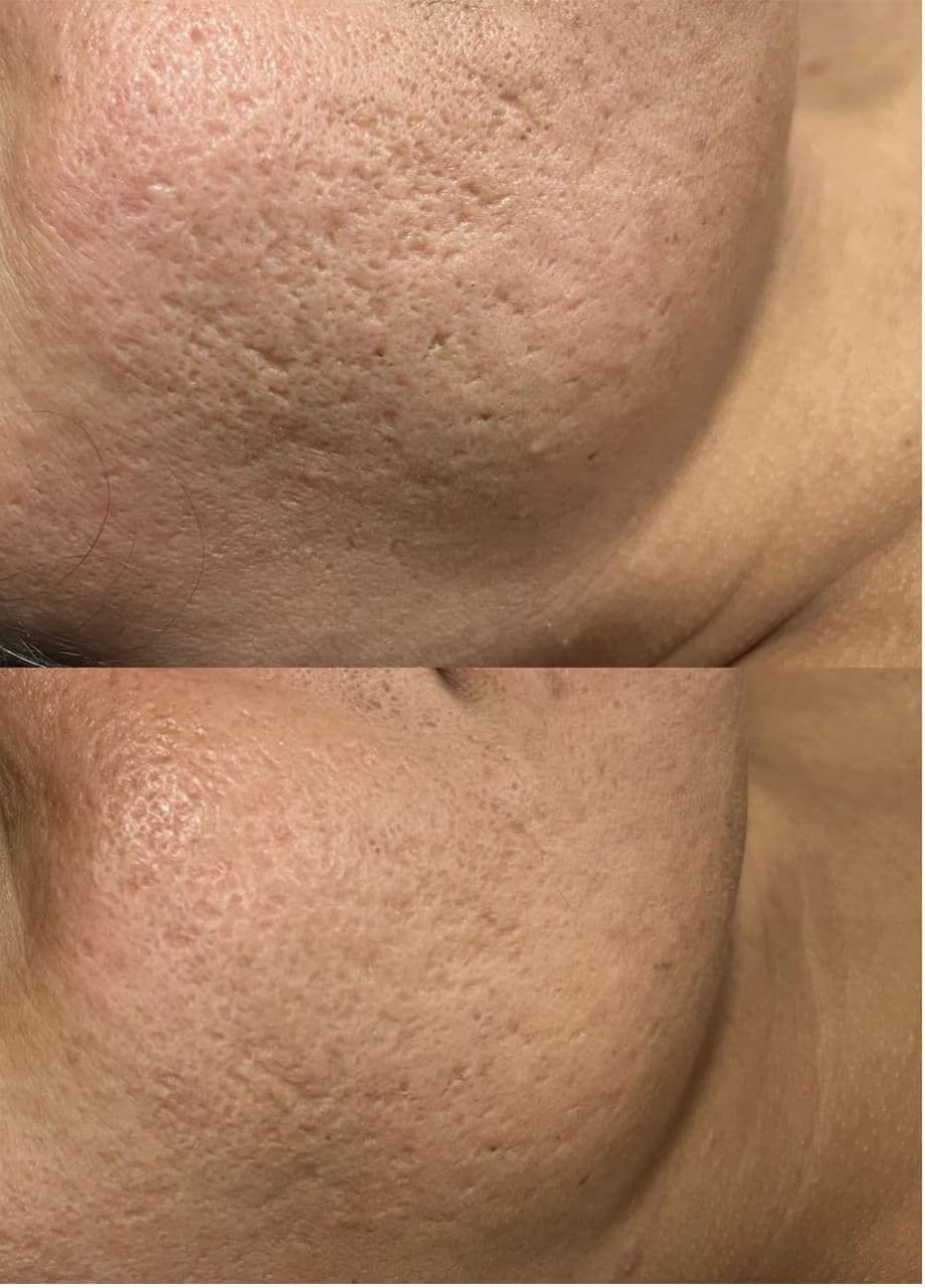Dermapen 4 foto 1